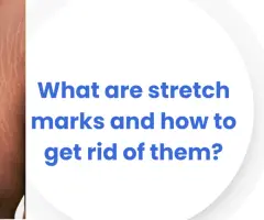 What are stretch marks and how to get rid of them?